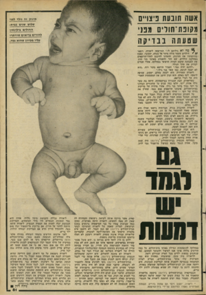 העולם הזה - גליון 2276 - 15 באפריל 1981 - עמוד 81 | אשת תובעת פיצויים מקופת־חורינ 1מפני שטעתהב בז־* ק ה תינוק זה נולד לפני שלוש שנים בבית- החולים גילינסון להוריס בריאים שוויתרו עליו מכיוון שהוא גמד. מיה לא